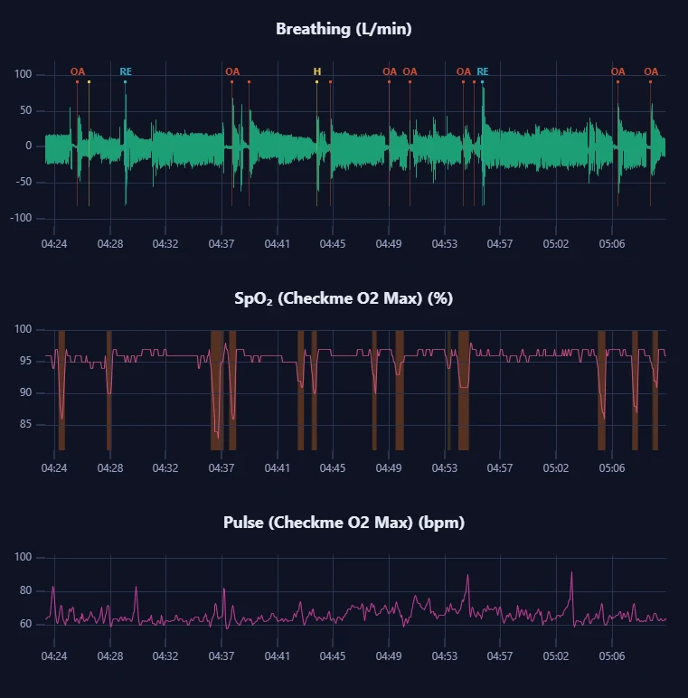 Forty-five minutes of one night: the breathing waveform with events marked, the oximeter's SpO₂ below it with each desaturation shaded, and the pulse.